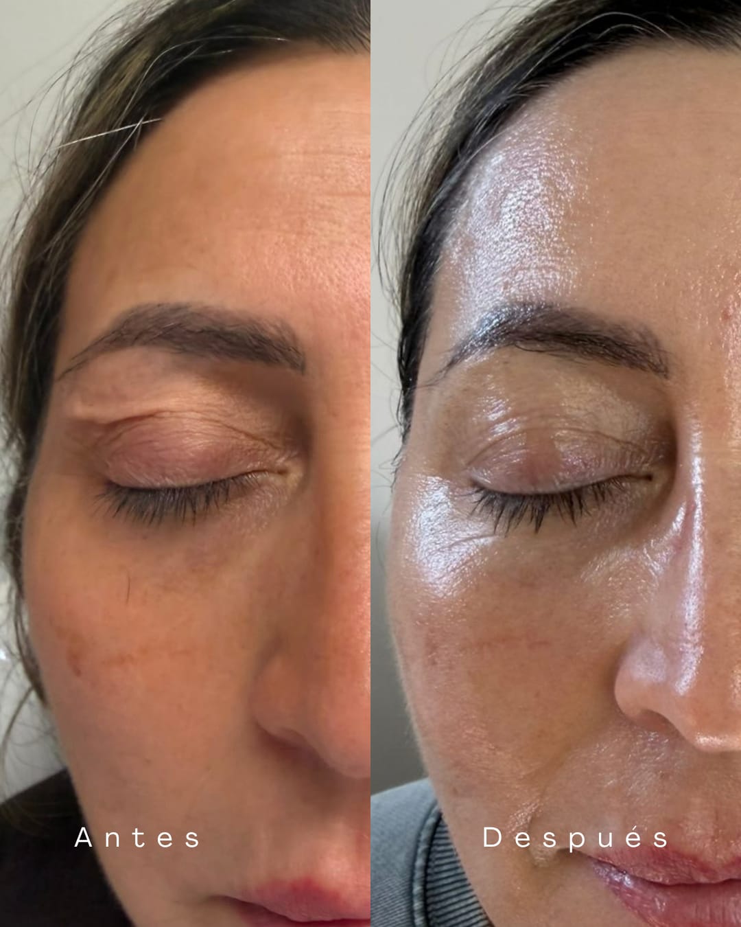 Párpado antes y después del tratamiento con Plexr